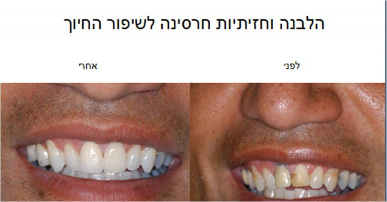 הלבנה וחזיתיות חרסינה