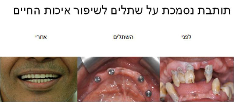 תותבת נסמכת על שתלים