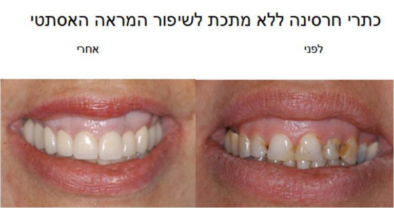 כתרי חרסינה לפני ואחרי